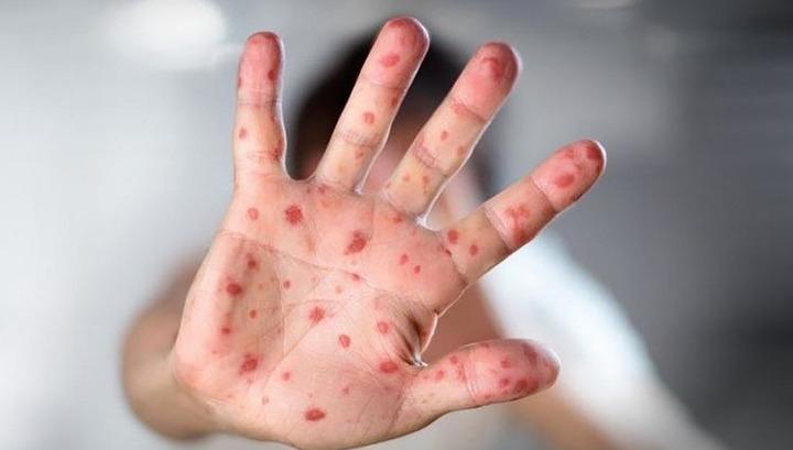 Չպատվաստված անձանց կուտակումը կարող է սպառնալ ՀՀ-ում կարմրուկի և կարմրախտի հետվերադարձին. ԱՆ