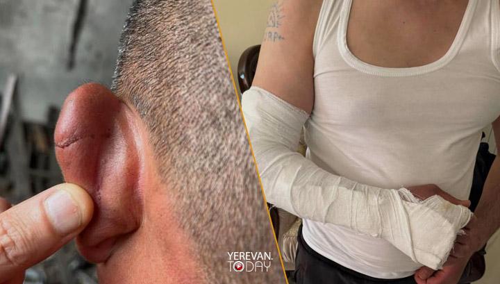 Դաժան ծեծի արդյունքում ոստիկանները կոտրել են մեկ քաղաքացու ձեռքը և վնասել մյուսի ականջը