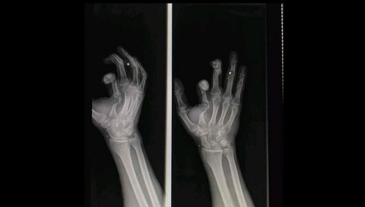 Այսօր ինձ զրկեցին հաշմանդամության կարգից և դա արեցին նիկոլ փաշինյանի հրամանով. Մանուել Մանուկյան