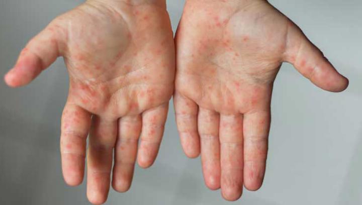 Կարմրուկի դեպքերի թիվը մեկ շաբաթում ավելացել է 20-ով